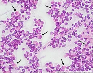 Image B: H&E stain smear, high magnification.