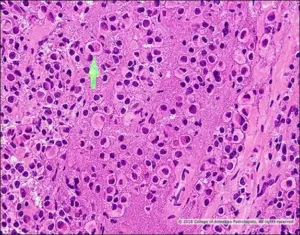 Image C: H&E stain frozen section, high magnification.