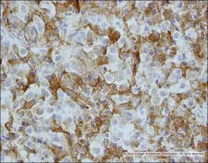 Image F: Adrenocorticotropic hormone (ACTH) IHC stain, high magnification.