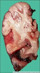 Image B: Gross image, occipital lobe, cut surface.