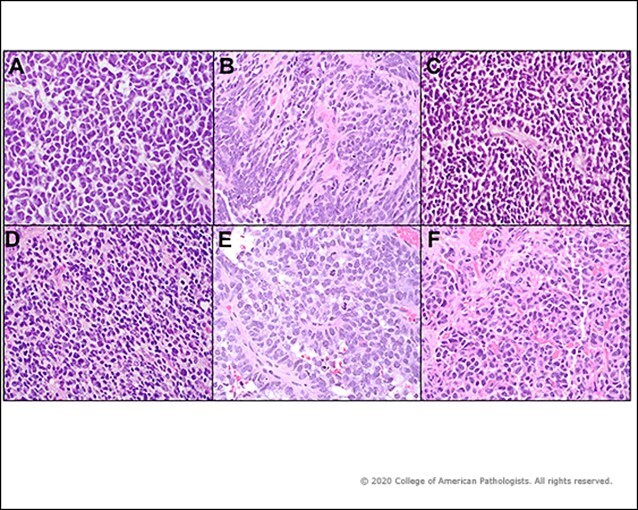 Image 1: Similar microscopic appearances among small round blue cell tumors. A) Medulloblastoma; B) Embryonal tumor with multilayered rosettes; C) Pineoblastoma; D) Glioblastoma with H3F3A G34R mutation; E) Choroid plexus carcinoma; F) Metastatic neurobla